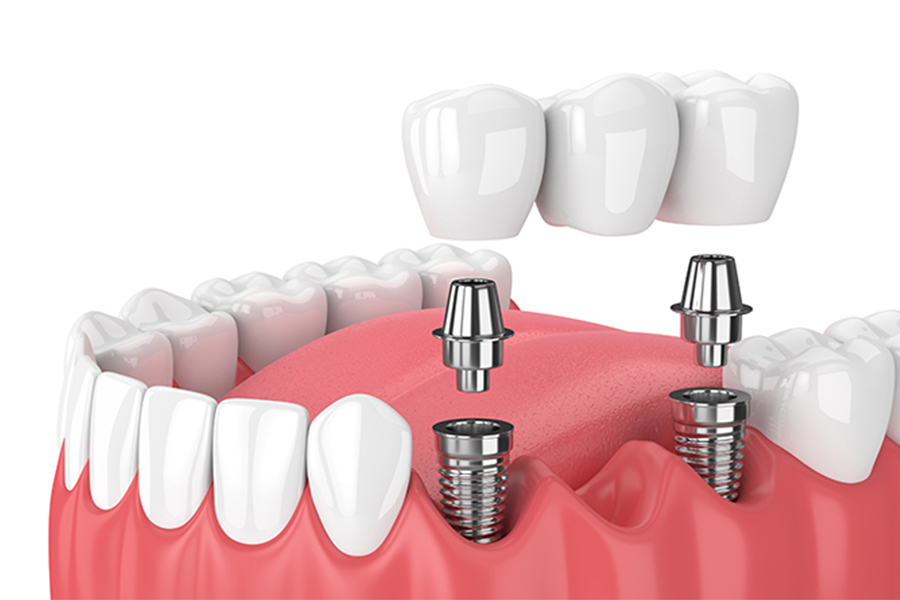 歯を失ってしまった方への治療法
