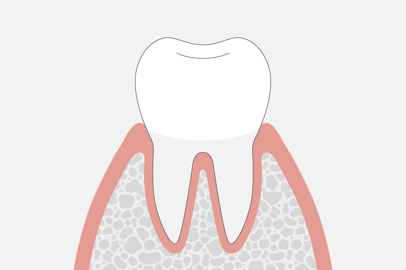 歯肉炎(歯周ポケットの深さ1〜2mm)
