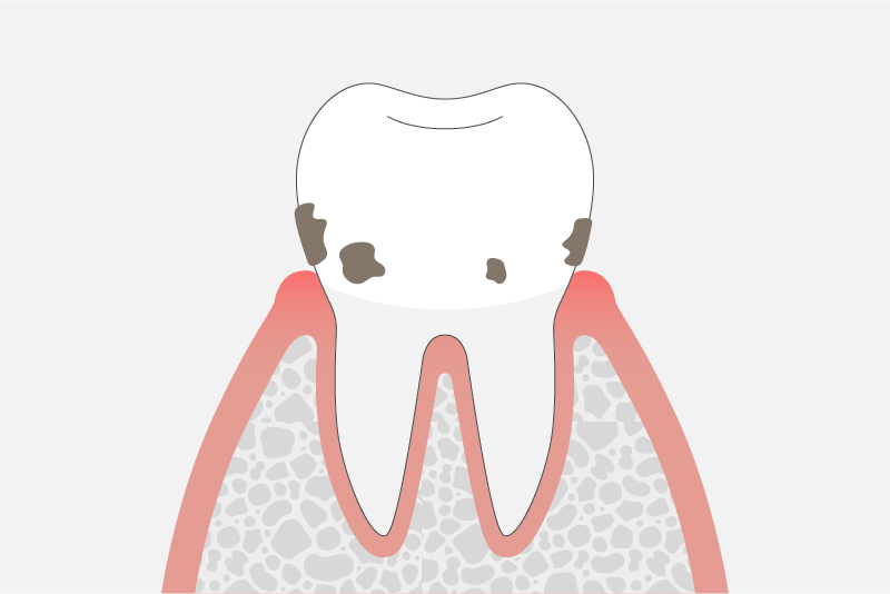 軽度歯周炎(歯周ポケットの深さ3〜4mm)