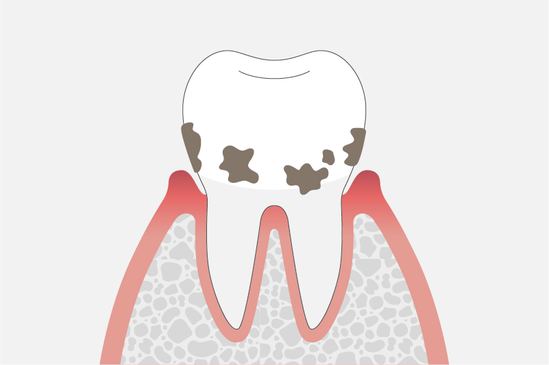 中等度歯周炎(歯周ポケットの深さ5~7mm)