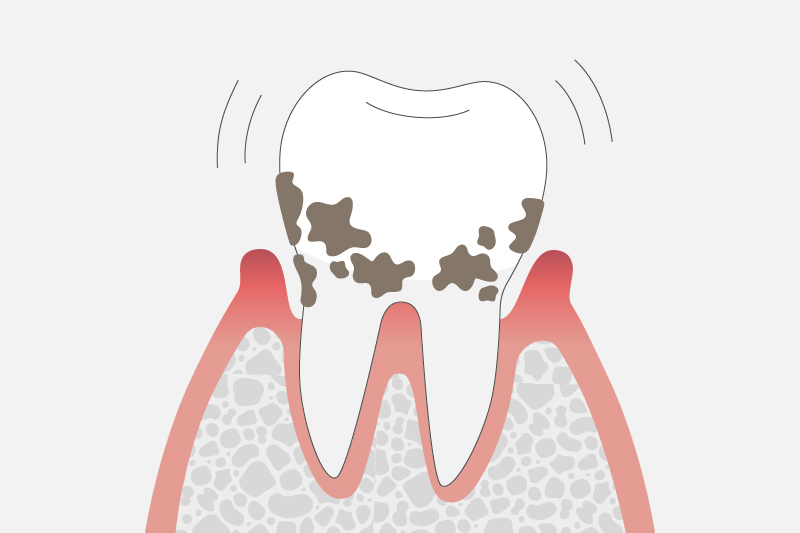 重度歯周炎(歯周ポケットの深さ7mm以上)